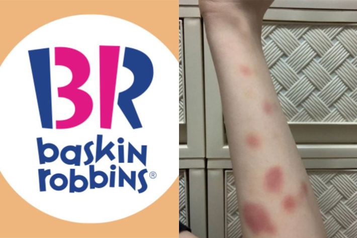 배스킨라빈스의 한 아르바이트생은 지난 9일부터 시작된 할인 행사 이후 "아이스크림을 푸다가 팔에 멍이 들었다"며 사진을 공개했다. 배스킨라빈스 공식 페이스북·해당 SNS 캡처