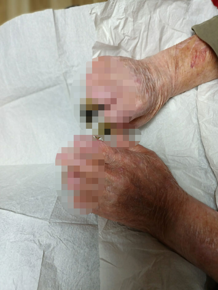 2015년 방광 내시경 검사를 받은 뒤 패혈증이 온 박모(80)씨. 현재는 손가락 일부가 떨어져 나갔다. 박씨 가족 측 제공.