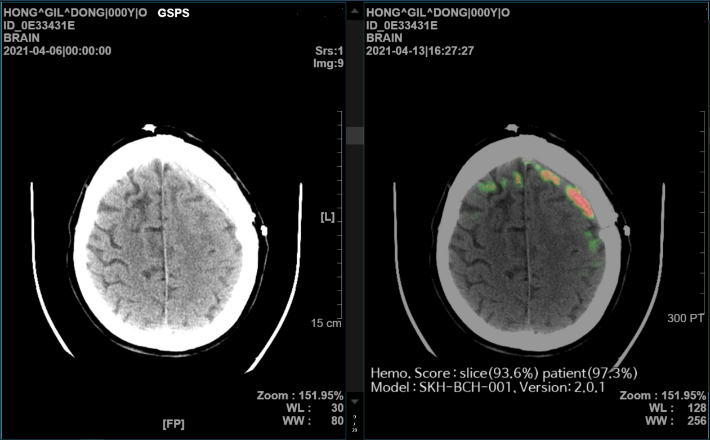 AI 뇌출혈 영상 의료 솔루션(메디컬 인사이트 플러스 뇌출혈) 데모(Demo) 화면. SK㈜ C&C 제공