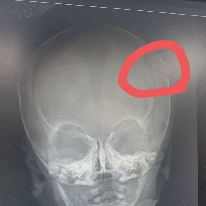 영아 보호자가 온라인 커뮤니티에 올린 두개골 골절 사진. 온라인 커뮤니티 캡처
