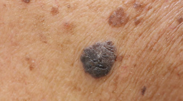 피부암. 서울대병원 제공