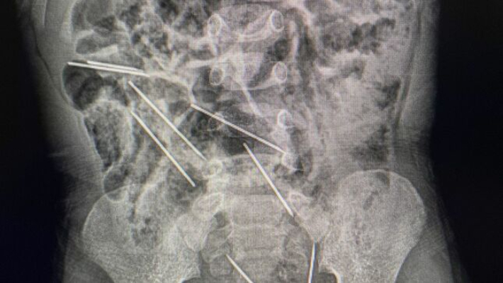 수술전 촬영한 X레이 이미지. 아이의 복부에서 주사바늘이 선명하게 보인다. 페루 산마르틴 지방정부 홈페이지 캡처