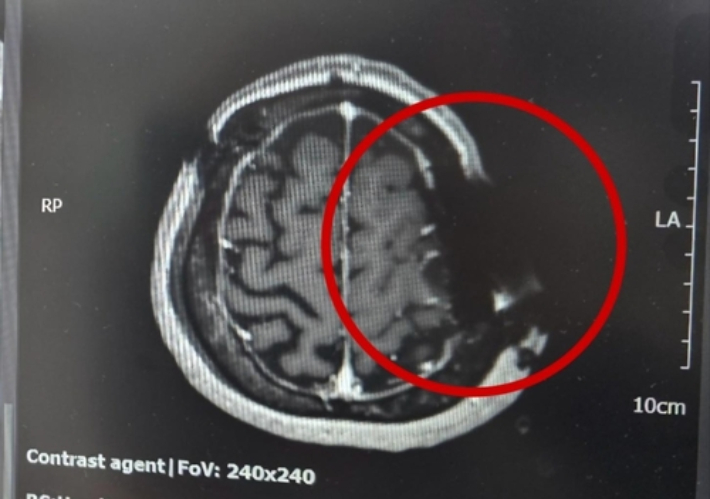 동그라미 부근의 머리뼈에 쇠톱 날이 박혀 자기공명영상(MRI)이 제대로 찍히지 않았다. MRI는 자기공명을 이용하는데 금속 물질이 있어 정상적으로 작동하지 않았다고 한다. 연합뉴스