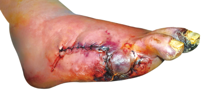 올 12월 23일부터 적용되는 제5기 담뱃갑 경고그림에 새롭게 포함된 말초혈관질환. 담뱃갑에는 '말초혈관질환으로 가는 길'이란 문구와 함께 담길 예정이다. 복지부 제공