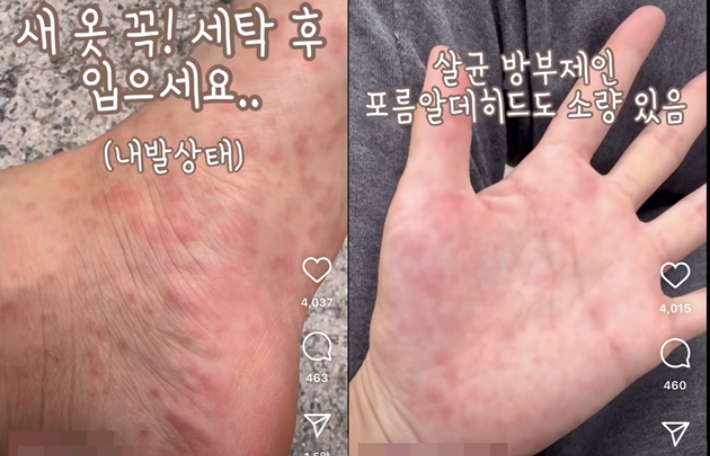 새 옷을 세탁하지 않고 입었다가 온 몸이 빨간 반점으로 뒤덮였다는 한 여성의 사연이 전해져 화제다. SNS 캡처