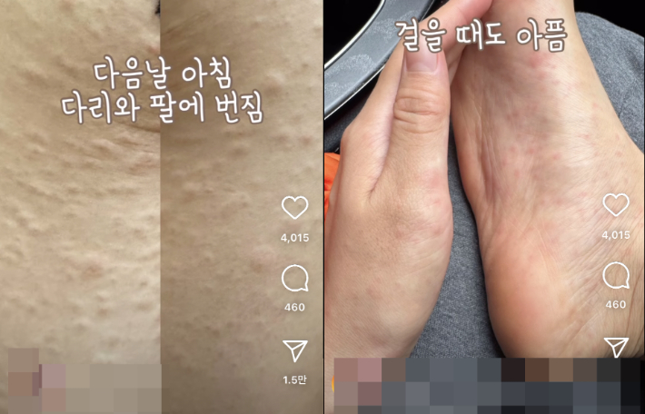 A씨는 "갑자기 발에 빨간 반점이 생기기 시작"했다며 "부풀며 가려웠고 다음날 아침 다리와 팔에 번졌다"고 설명했다. SNS 캡처