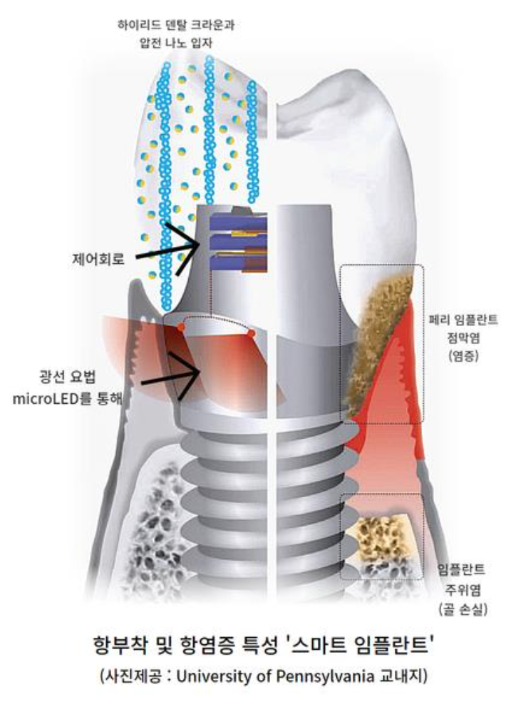 항부착 및 항염증 특성 '스마트 임플란트' 이미지. 황길수 박사측 제공