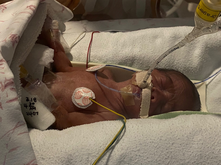 환아(쩐푹안, 남)가 인큐베이터 안에서 치료를 받고 있는 모습. 강릉아산병원 제공