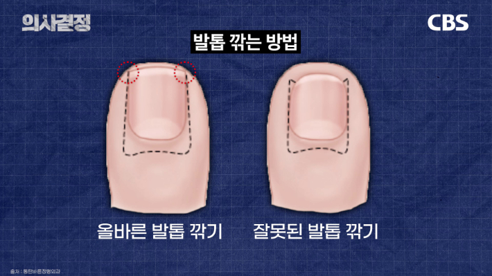 하얀 발톱 다 잘랐다고요? 그게 내성 발톱의 시작입니다[의사결정]