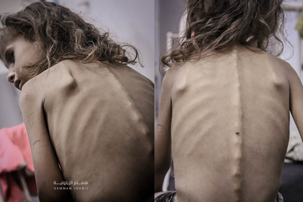 굶주림에 뼈가 앙상하게 드러난 가자지구의 소녀 '마이'. 살갗에 도드라진 뼈 위로 파리 한 마리가 붙어있다. X 캡처