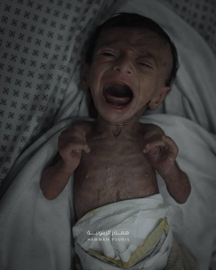 4개월 된 아기 '할라스'는 전쟁으로 인해 심각한 영양실조에 시달리고 있다. X 캡처