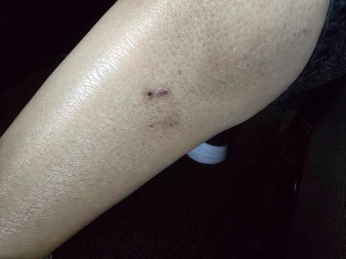 개물림 사고 한 달 후 남아있는 흉터 사진. 온라인 커뮤니티 캡처
