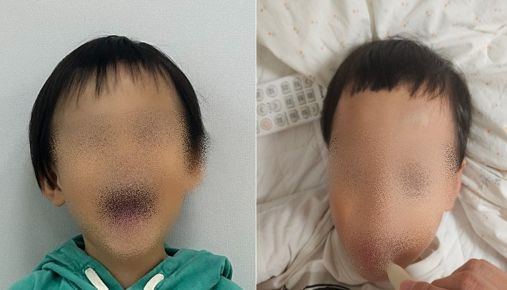 대전 유성구의 한 어린이집에서 귀가한 아이의 머리카락이 잘려오는 등 아동학대 의혹이 불거져 대전 경찰이 수사에 나섰다. 머리카락이 잘리기 전 후 모습. 학부모 제공