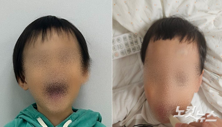 대전 유성구의 한 어린이집에서 귀가한 B(3)군의 머리카락이 잘려오는 등 아동학대 의혹이 불거져 대전 경찰이 수사에 나섰다. 머리카락이 잘리기 전 후 모습. 학부모 제공
