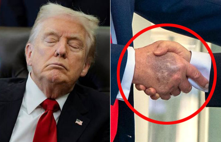 6일(현지시각) 백악관 대통령 집무실에서 열린 공식행사에서 조는 모습을 보인 트럼프 대통령(왼쪽)·미국 워싱턴 백악관에서 이재명 대통령과 악수한 도널드 트럼프 미국 대통령 손등에 푸른색 멍이 크게 들어 있다. 연합뉴스