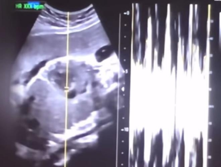 낙태한 산모의 유튜브 동영상에서 캡쳐한 초음파 사진과 심박 그래프. 연합뉴스