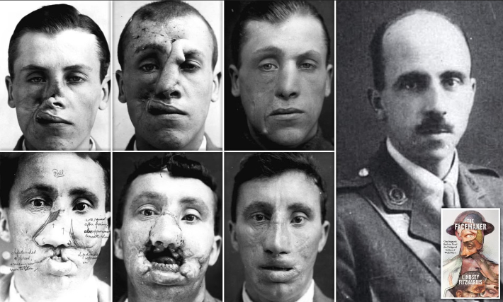 시드니 벨덤 하사는 파스샹달 전투에서 전사자 시신 수습 중 기적적으로 숨이 붙은 채 발견돼 후송됐다. 그는 길리스의 집도 아래 거의 40번의 얼굴 재건 수술을 받았다. 벨덤 하사는 병원에서 만난 여성과 결혼해 이후 60년을 더 살았다. 우측 사진은 헤럴드 길리스와 '페이스 메이커' 영문판. 