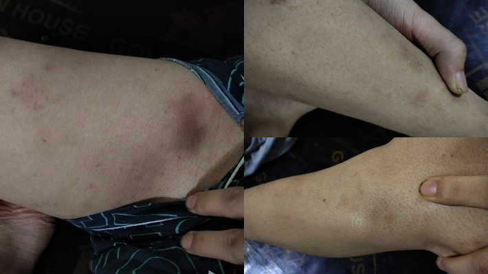 선호씨 몸에 아직 남아있는 폭행의 흔적들. 선호씨 제공