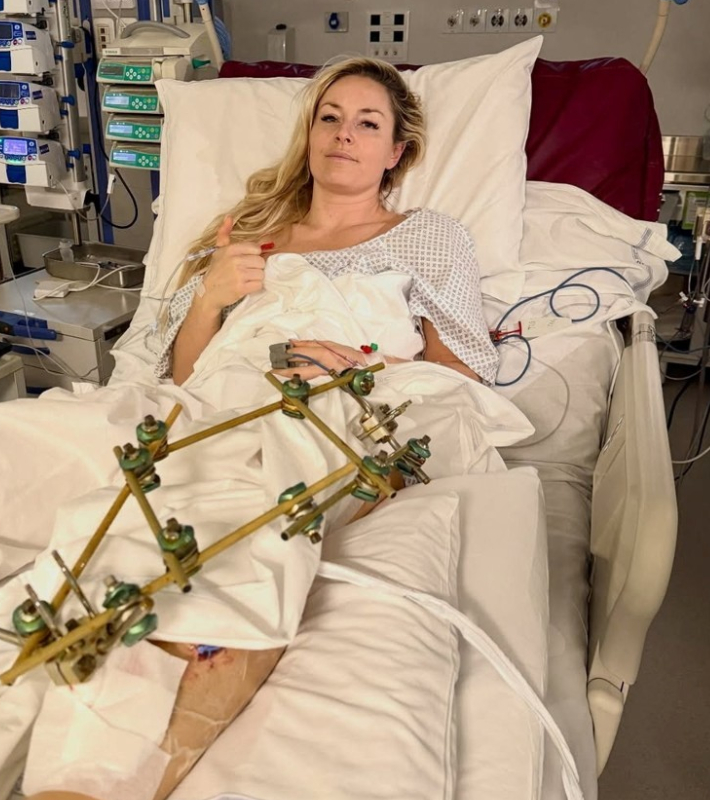 다리 수술을 받은 린지 본. 린지 본 인스타그램 캡처