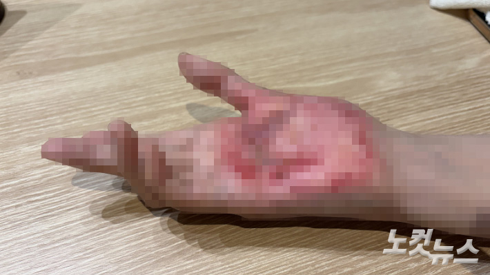 취재진에게 보여준 엄씨의 손은 다친 지 7개월이 지났지만 여전히 구축된 채로 굳어있었다. 박인 기자