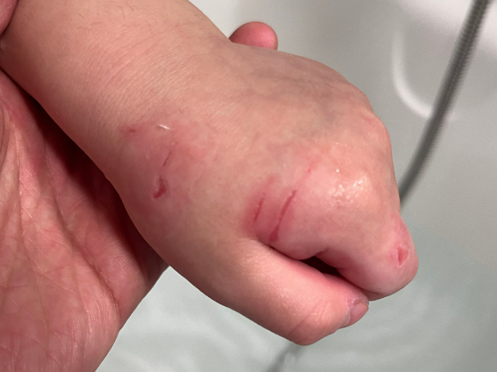 아이 손 여기저기에 상처가 나 있는 모습. 독자 제공