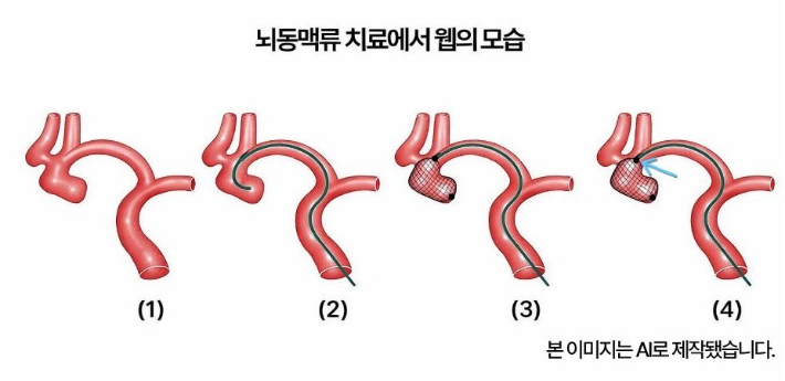  (1) 전교통동맥의 뇌동맥류 (2) 미세카테터로 뇌동맥류를 선택한 모습 (3) 웹을 뇌동맥류 안으로 삽입한 상태 (4) 웹을 밀면. 포항세명기독병원 제공