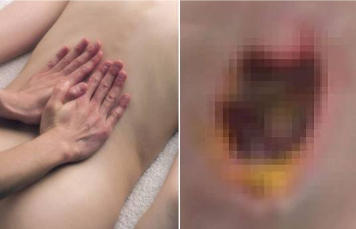 마사지사의 황당 서비스, 피부 괴사로 이어졌다[어텐션 뉴스]