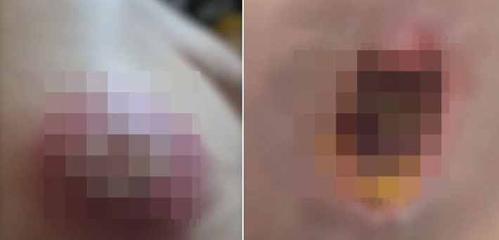 불법 시술로 점을 제거한 자리가 괴사된 모습. SBS 보도 화면 캡처